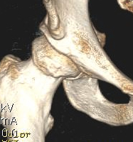 3D CT Hip